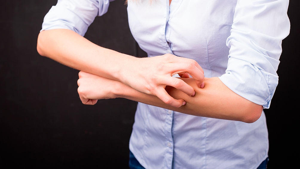 Se caracteriza principalmente por piel seca, prurito intenso y lesiones cutáneas inflamatorias localizados (eccemas).