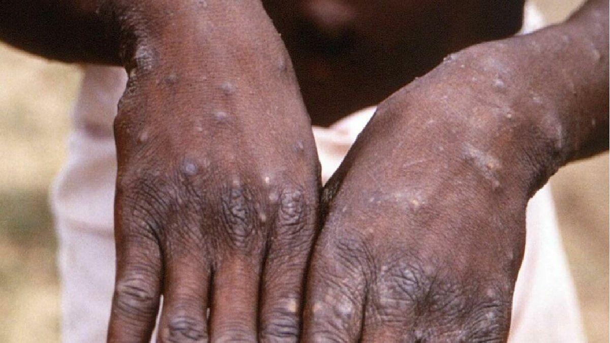 Confirman la transmisión comunitaria de la viruela del mono en el Reino Unido