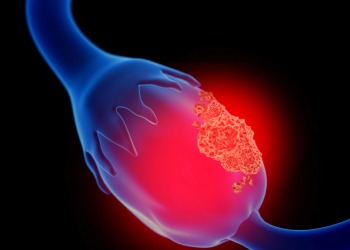 En el Día Mundial del Cáncer de Ovario: cuáles son sus síntomas y cómo prevenirlo