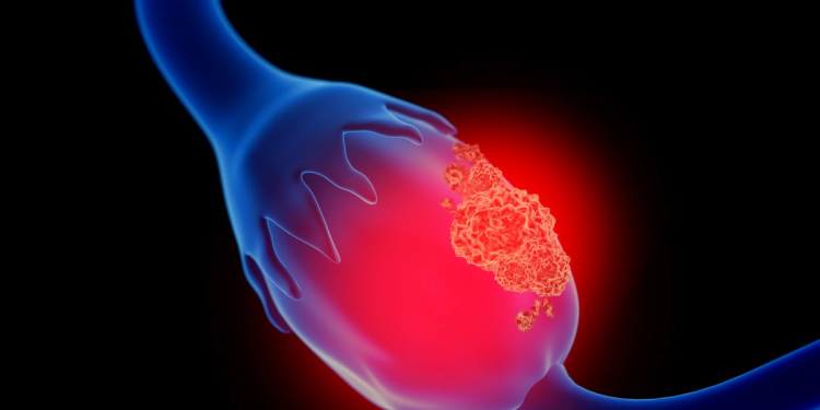 En el Día Mundial del Cáncer de Ovario: cuáles son sus síntomas y cómo prevenirlo