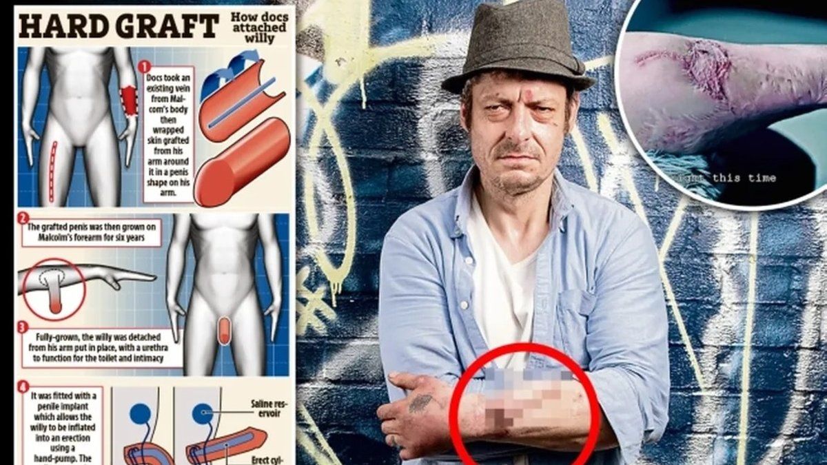 Vivió seis años con pene injertado en el brazo y gracias a un increíble procedimiento pudieron ponerle uno nuevo