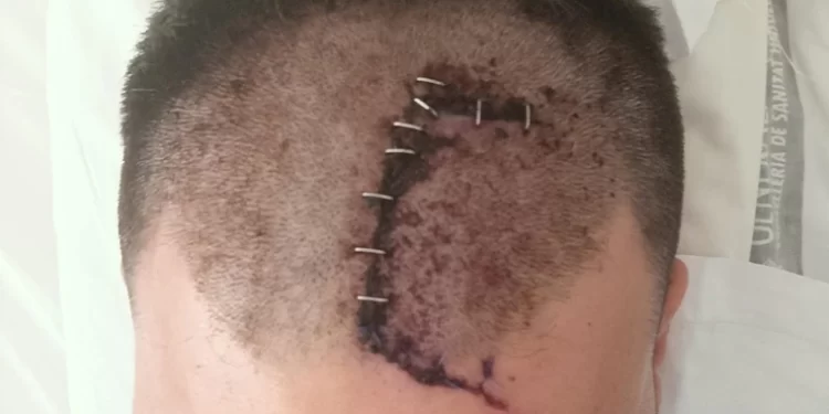 La lenta recuperación de J. tras una salvaje agresión por ser policía: «Mi día a día es estar en casa, en el sofá»>