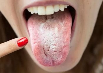 Lengua blanca: qué significan estas manchas y cómo eliminarlas en un santiamén
