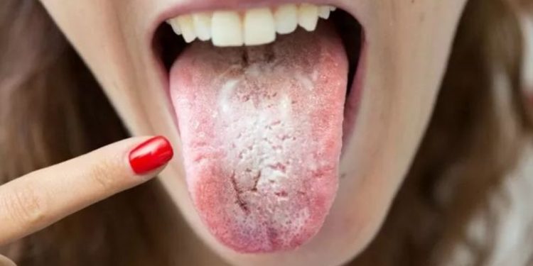 Lengua blanca: qué significan estas manchas y cómo eliminarlas en un santiamén