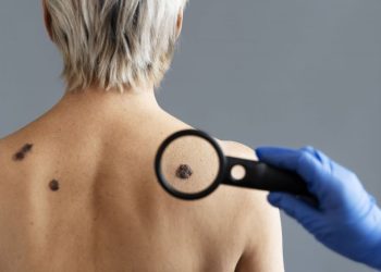 El método casero para quitar las verrugas para siempre: así podrás evitarlas y tener una piel más saludable