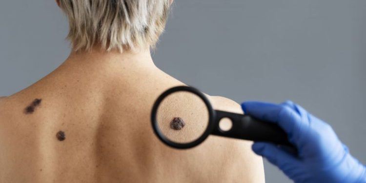 El método casero para quitar las verrugas para siempre: así podrás evitarlas y tener una piel más saludable