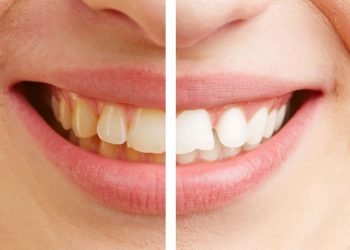 La mezcla mágica que ayuda a quitar el sarro de los dientes de forma definitiva