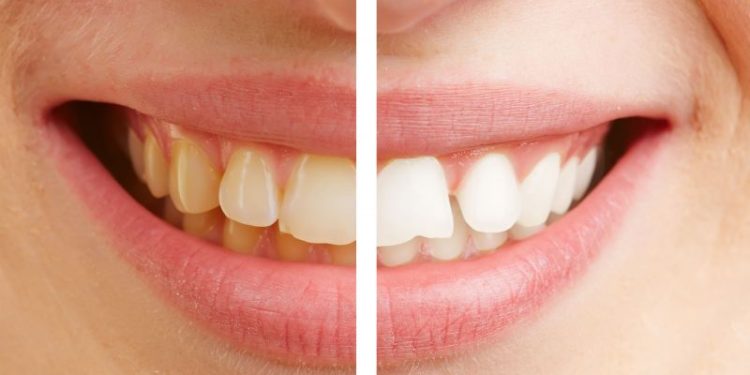 La mezcla mágica que ayuda a quitar el sarro de los dientes de forma definitiva