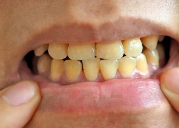 Ni vinagre ni bicarbonato: el método definitivo para erradicar el sarro de los dientes y no tener mal aliento