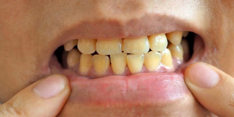 Ni vinagre ni bicarbonato: el método definitivo para erradicar el sarro de los dientes y no tener mal aliento